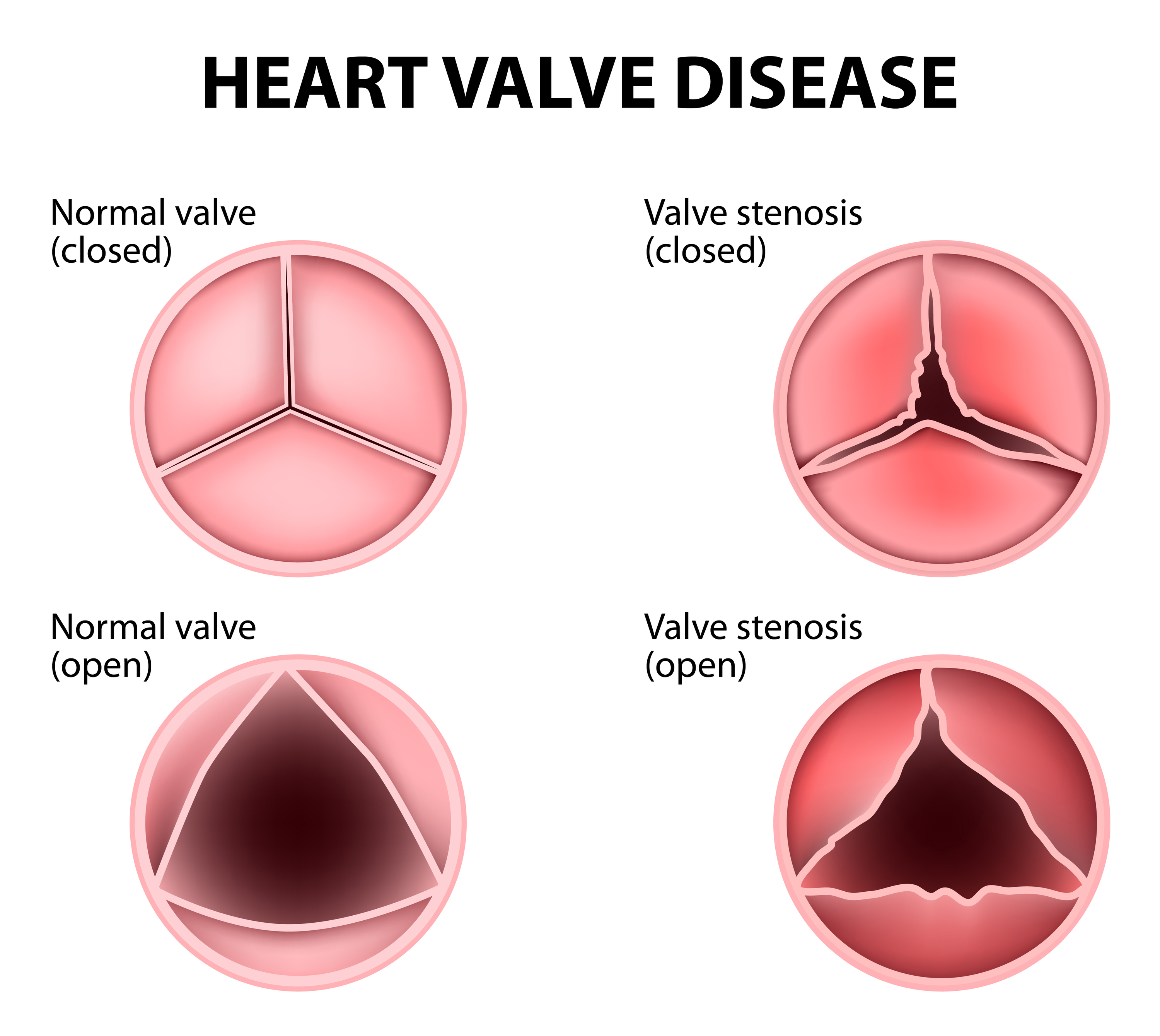 What Are Heart Valve Flaps Dr Peter Mikhail